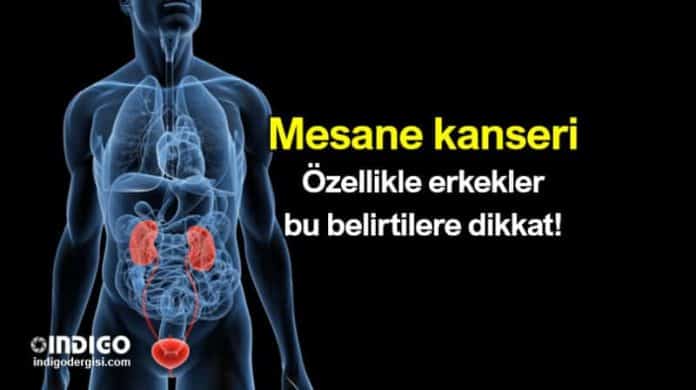 Mesane T M R Nedir Mesane Kanseri Belirtileri Neler