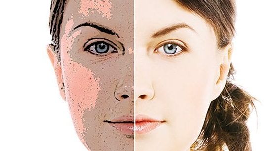 sedef hastalarının