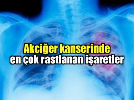 Akciğer kanseri belirtileri nelerdir?