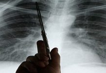 Akciğer kanserinin 7 belirtisi nelerdir? Akciğer Kanserinin 7 belirtisi nelerdir?