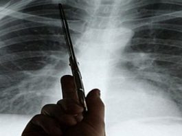 Akciğer Kanserinin 7 belirtisi nelerdir?