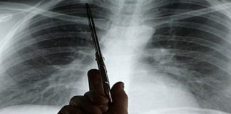 Akciğer Kanserinin 7 belirtisi nelerdir?