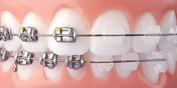 Ortodontik tedavi nedir? Diş tedavisi korkusuna lazerli çözüm