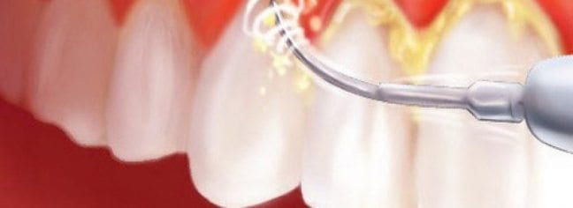 Diş taşı (tartar) nasıl oluşur? Temizliği nasıl yapılır?