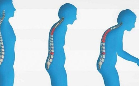 Menopoz kemiklerinizi eritmesin! Kemik erimesi tedavi edilebiliyor!