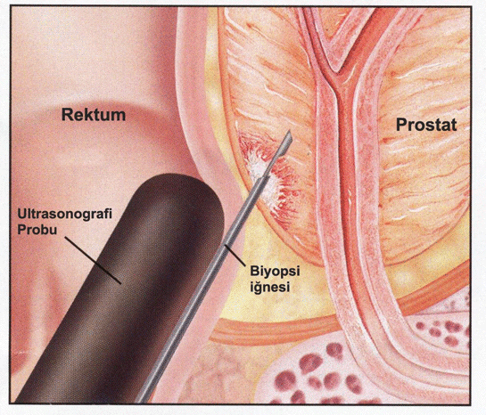 Prostat kanseri tanısı nasıl konulur?