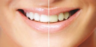 Diş beyazlatma seçenekleri nelerdir?