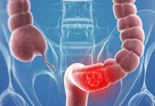 Kolon kanseri riskini 11 adımda azaltın Kolon kanseri riskini 11 adımda azaltın