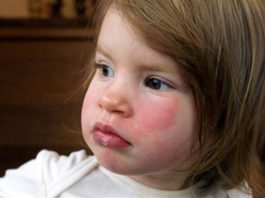 Tokatlanmış yanak sendromu nedir? Nasıl tedavi edilir?