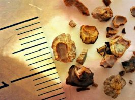 Böbrek taşı neden oluşur? Tedavisinde neler yapılmalı?