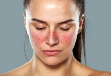 Kelebek hastalığı (Lupus) nedir? Kelebek hastalığı (Lupus) nedir? Hamileleri tehdit ediyor!