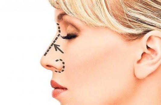 Rinoplasti ameliyatı nedir? Güzel bir buruna sahip olmak zor değil!