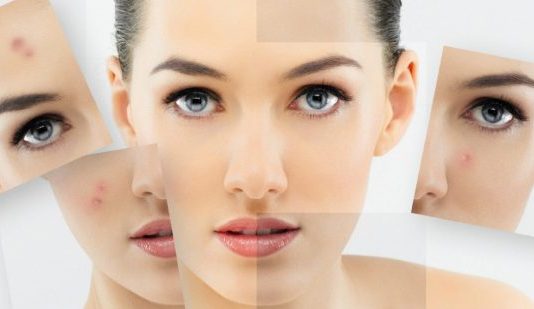 Akne sorunundan kurtulmak için neler yapılmalı?