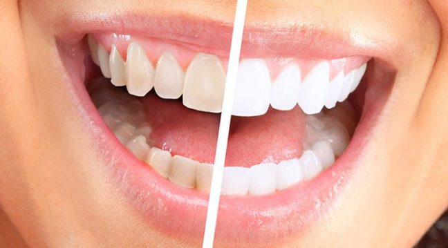 Diş beyazlatma dişlere zarar veriyor mu?