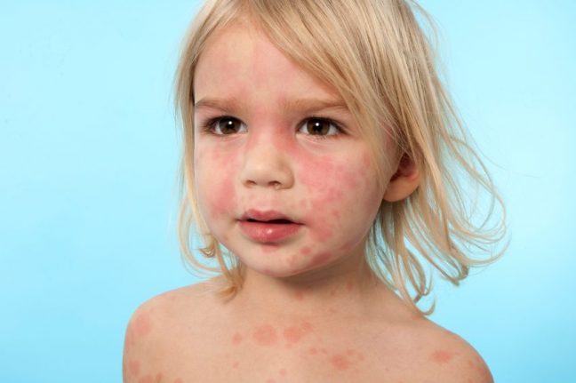 Besin alerjileri neden kaynaklanır? Bu belirtilere dikkat!