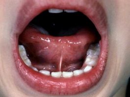 Dil bağı (ankiloglossi) hastalığı nedir? Belirtileri ve tedavisi nasıldır?