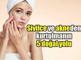Sivilcelerden kurtulmanın 5 doğal yolu sivilce akne tedavisi nasıl geçer