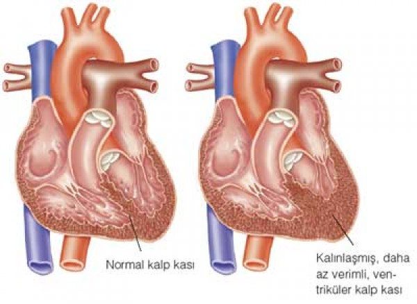kalp kası ve yüksek tansiyon hipertansiyon araştırması