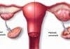 Polikistik Over Sendromu nedir? Her 4 kadından 1'inde görülüyor!