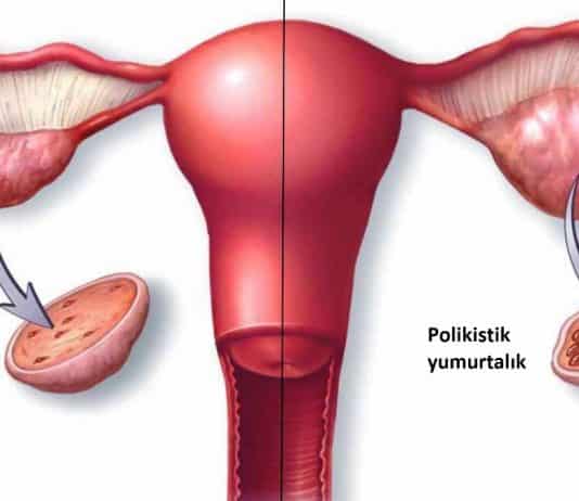 Polikistik Over Sendromu nedir? Her 4 kadından 1'inde görülüyor!
