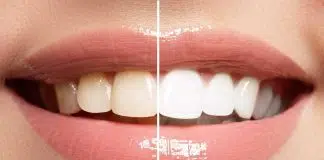 Bleaching