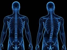 Skolyoz nedir? Özellikle 9 - 16 yaş arasındaki çocuklara dikkat!