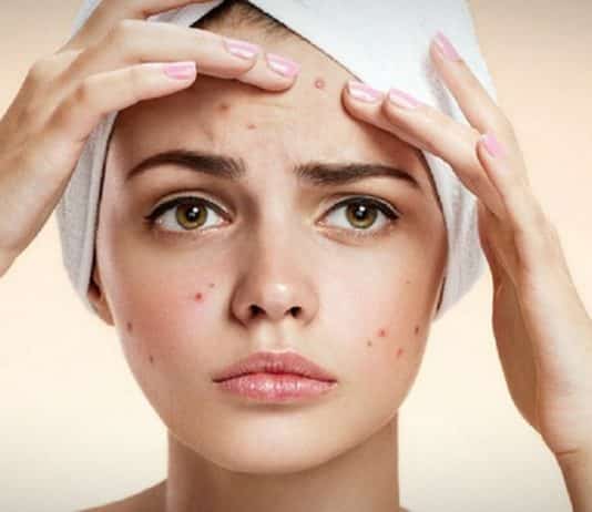 Vücutta çıkan sivilceler hastalık belirtisi olabilir mi?