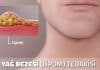 Yağ bezesi (lipom) nedir? Uzmanlar hızlı büyüyen bezelere karşı uyarıyor! yağ bezesi lipom