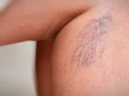 Derin Ven Trombozu nedir