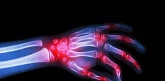 İltihaplı eklem romatizması Romatoid Artrit