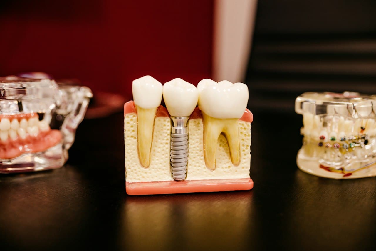 Diş implantı modeli