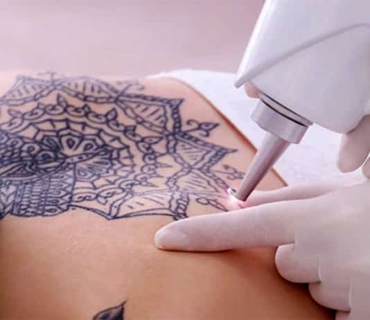 Pico: Lazer ile dövme sildirme nasıl yapılır?