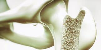 osteoporoz kemik erimesi