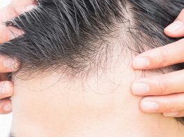 Saç ekimi hangi saç tipleri için ideal