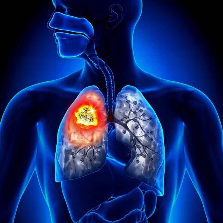 Akciğer kanseri belirtileri neler? Nasıl tedavi edilir?