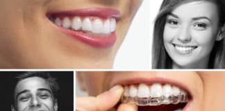 Şeffaf aparey (diş teli) tedavisi nedir? Nasıl yapılır?