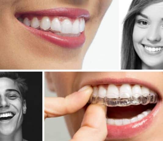 Şeffaf aparey (diş teli) tedavisi nedir? Nasıl yapılır?