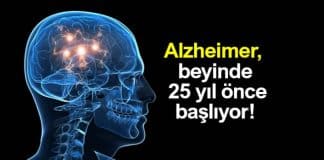 Alzheimer beyinde 25 yıl öncesinde başlıyor!