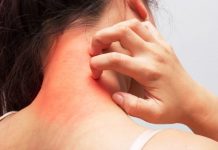 Kaşıntı neden olur? Kaşıntıya karşı 10 etkili yöntem Kaşıntı neden olur? Kaşıntıya karşı 10 etkili yöntem