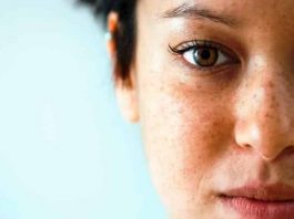 Güneş lekeleri için çözüm krem mi lazer mi?