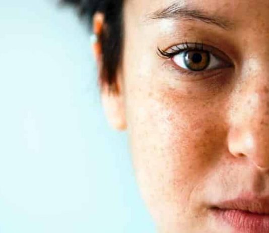 Güneş lekeleri için çözüm krem mi lazer mi?