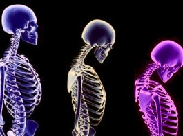 Osteoporoz nedir? Kemik erimesinden korunmak için 6 öneri