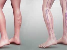 varis tedavisi çorabı