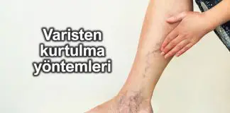 Varis tedavi edilmezse pıhtı oluşumuna neden olabilir! Varis tedavi edilmezse pıhtı oluşumuna neden olabilir!