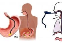 Mide botoksu nedir? Mide botoksu nedir?