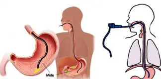 Mide botoksu nedir? Mide botoksu nedir?