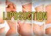 Neden Liposuction tercih etmeliyiz? Liposuction etkileri