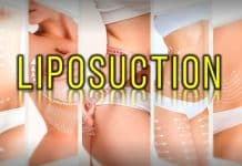 En güncel 10 Liposuction Doktoru (2026 Güncellendi) Liposuction etkileri