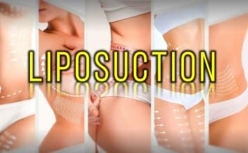 En güncel 10 Liposuction Doktoru (2026 Güncellendi) Liposuction etkileri