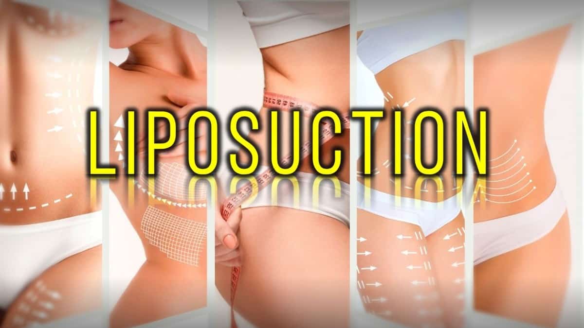 Liposuction etkileri